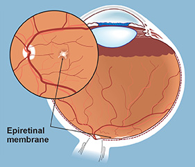 An epiretinal membrane occurs in some eyes after the vitreous gel collapses and pulls away from the front surface of the retina, the light sensitive layer at the back of the eye.