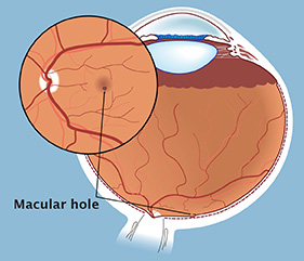 The macula is the central portion of the retina, the light sensitive layer at the back of the eye.