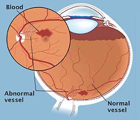 In proliferative diabetic retinopathy abnormal blood vessels develop on the retina. These vessels can lead to visual loss through bleeding or scar tissue formation.