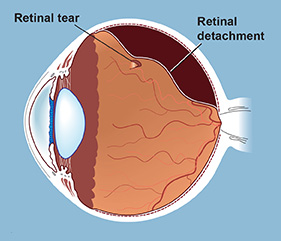 The retina is the thin, light-sensitive layer of tissue that lines the inside back wall of the eye. 
